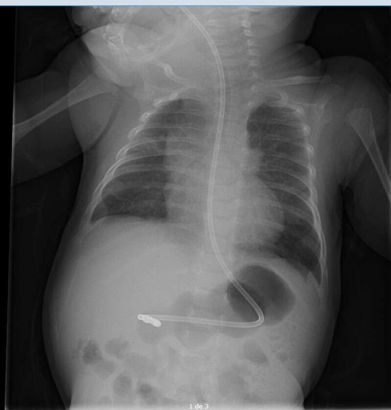 Figure 1. Chest-abdomen x-ray with notable peristaltic waves in the stomach due to HPS.